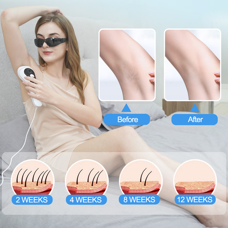 IPL Laser Hair Removal for Women With ICE & 999,999 Flashes